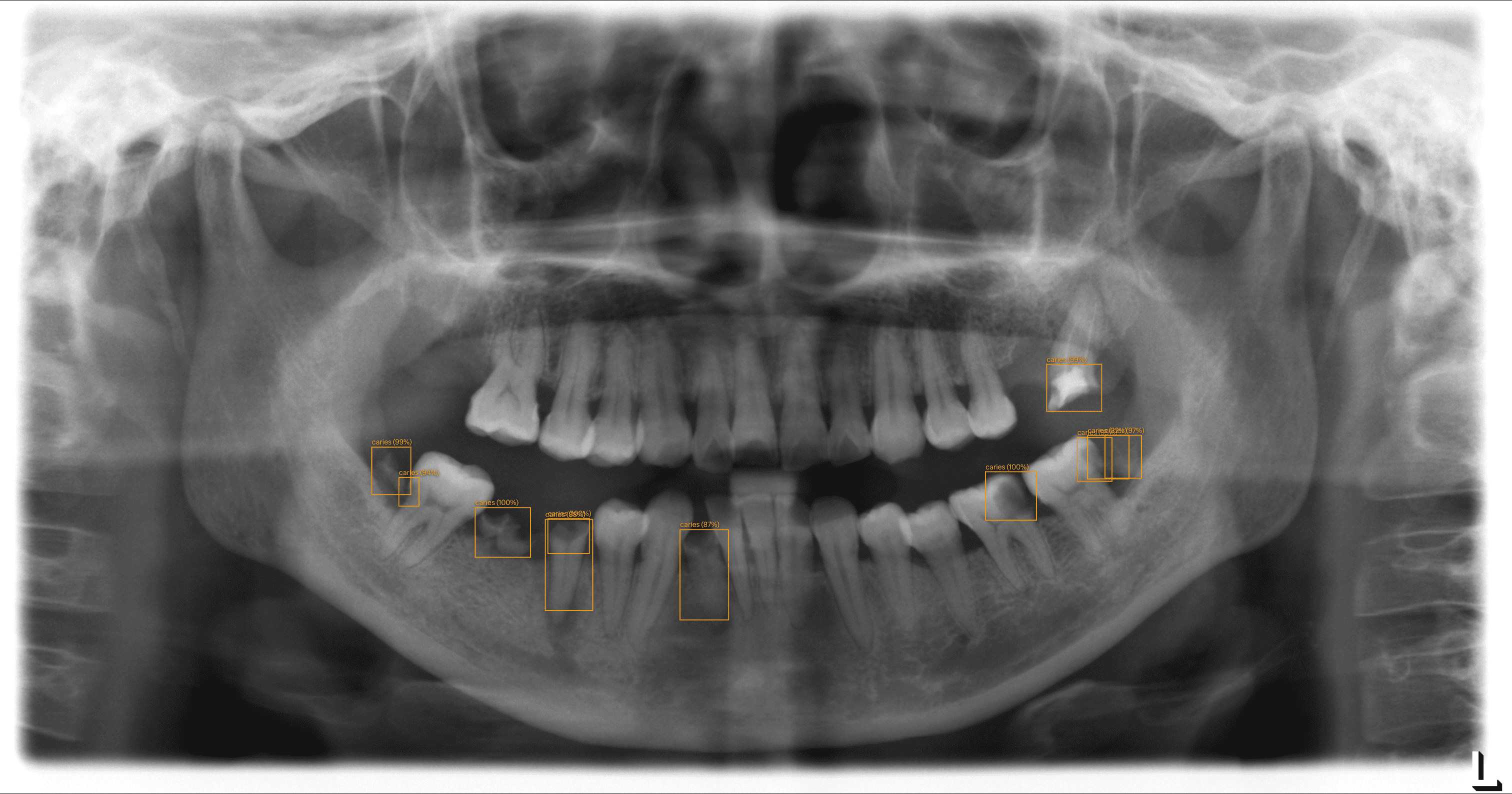 Dashboard d'imagerie — détection IA caries activée