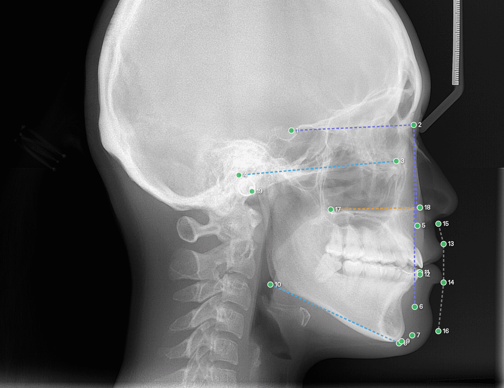Tracé céphalométrique avec points de repère