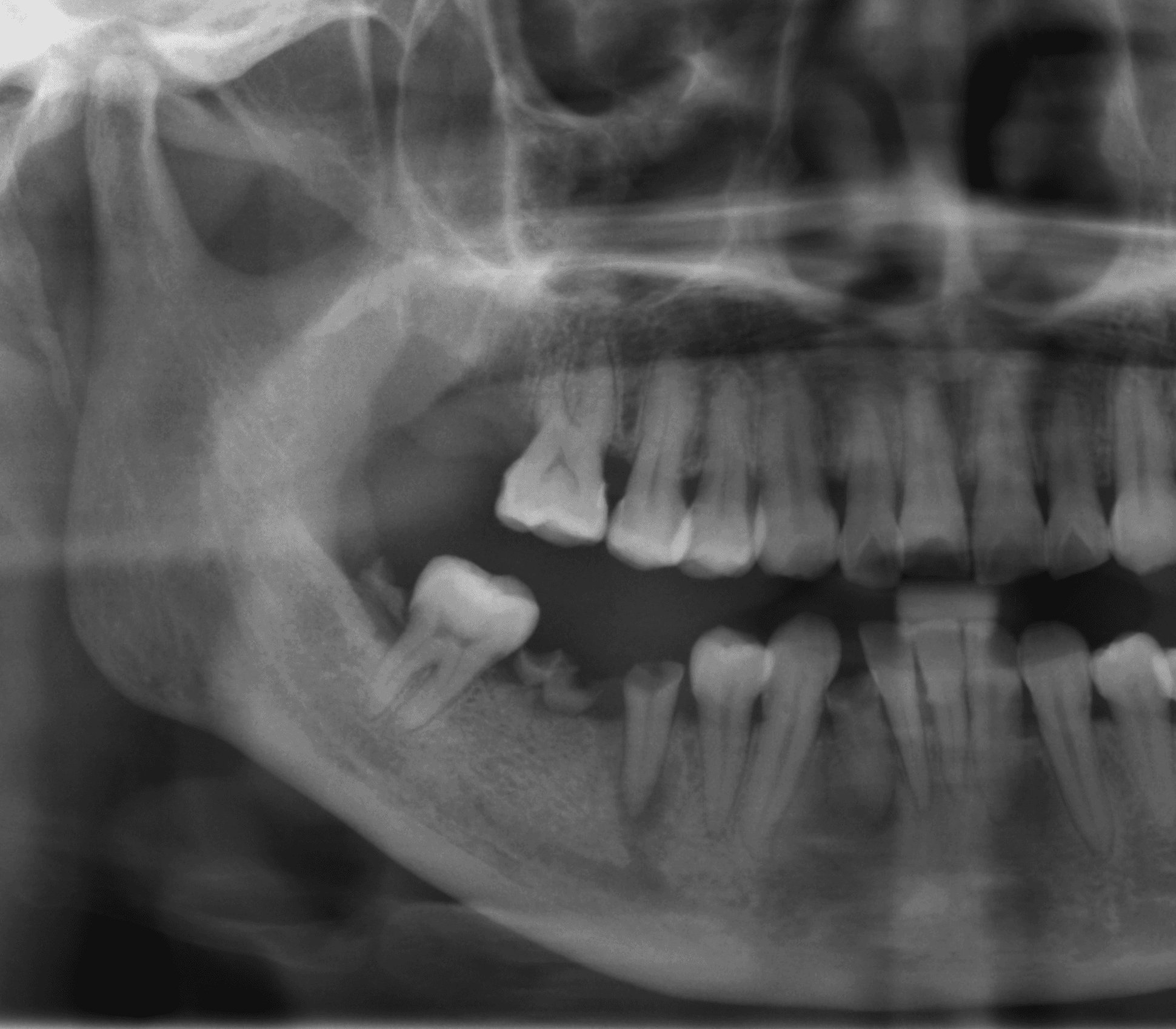 Radiographie panoramique — vue brute