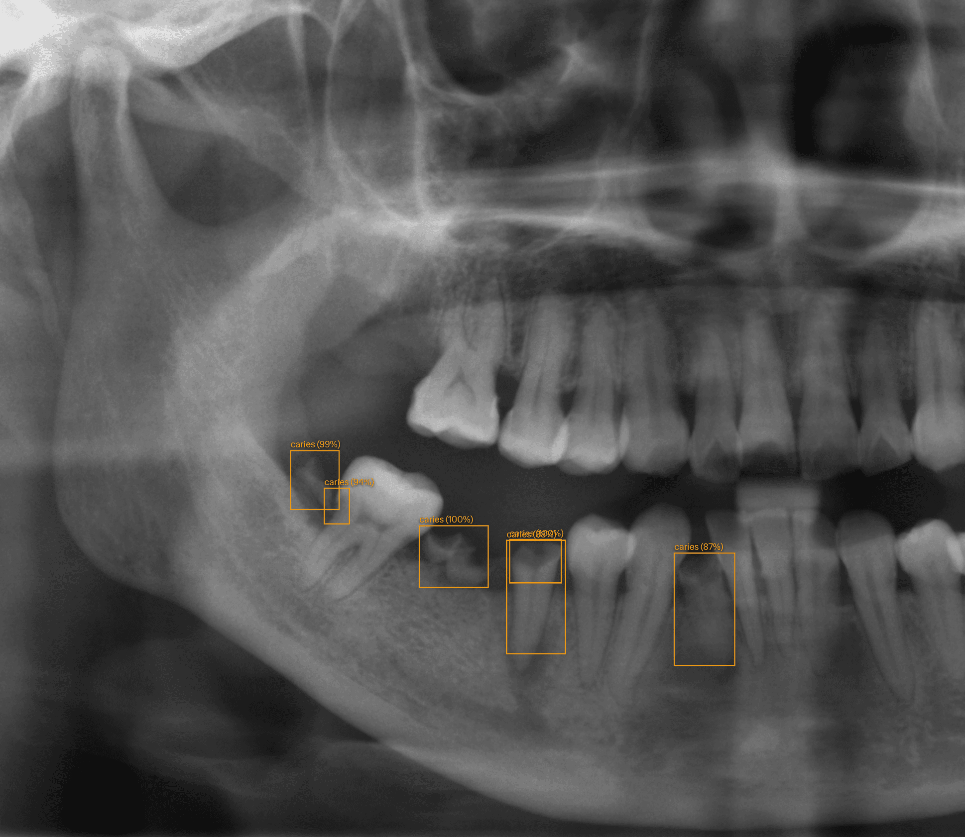Radiographie panoramique — détection IA caries